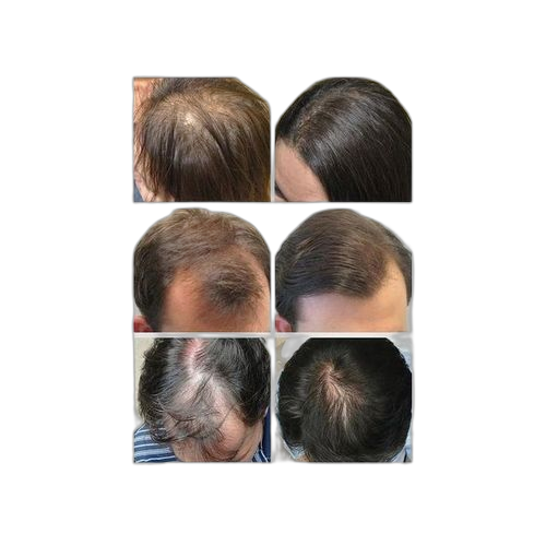 Huiles essentielles à base de plantes à croissance des cheveux 20ml